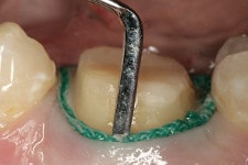 dental impression procedure: retraction cord placement