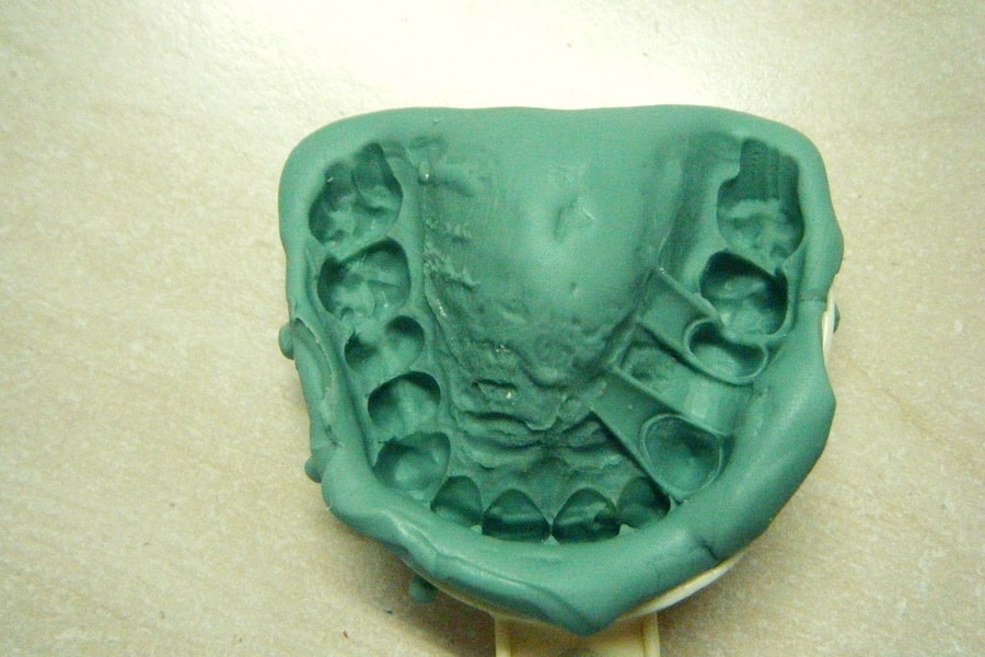 dental impression procedure: impression after the rigid material sets