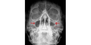 sinus X-ray