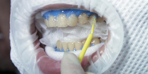 отбеливание зубов у стоматолога