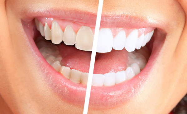 зубы до и после отбеливания