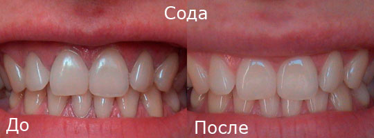 Отбеливание зубов содой: фото до и после