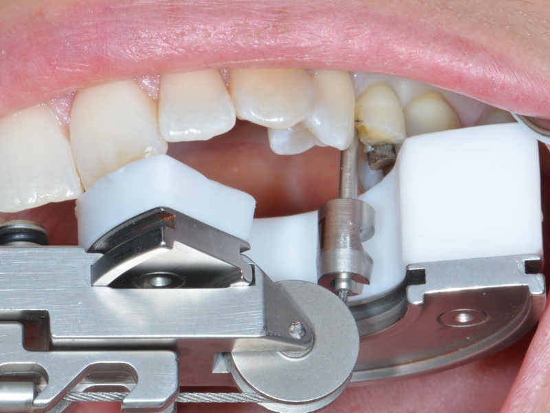This Innovative Tool Could be the Answer to Pain-Free Tooth Extractions