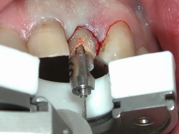 This Innovative Tool Could be the Answer to Pain-Free Tooth Extractions