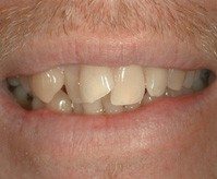 Crooked teeth - before