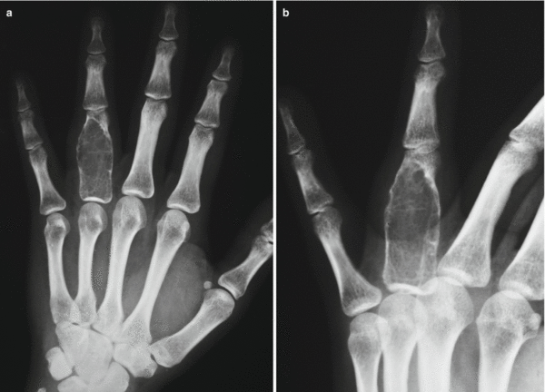 Гигантоклеточная репаративная гранулёма в костях пальца