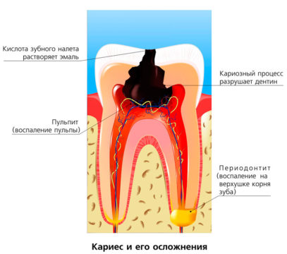 Разрушение зуба кариозным процессом