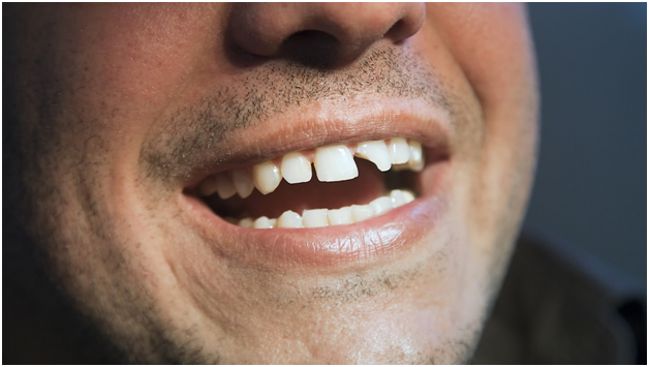 мужчина со сломанным зубом