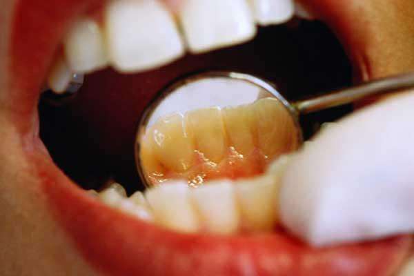 черные зубы с внутренней стороны причины