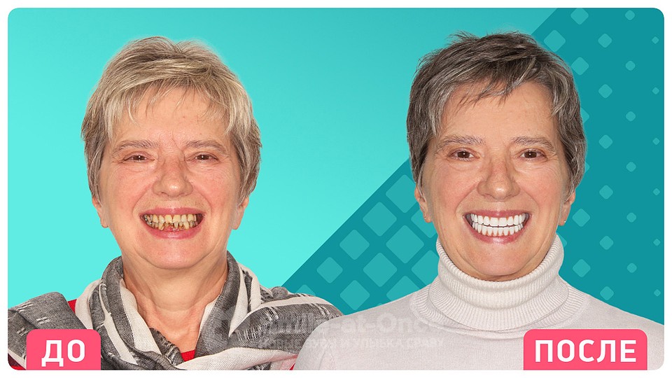 Так меняются пациенты после проведения имплантации зубов в клинике Smile-at-Once. 