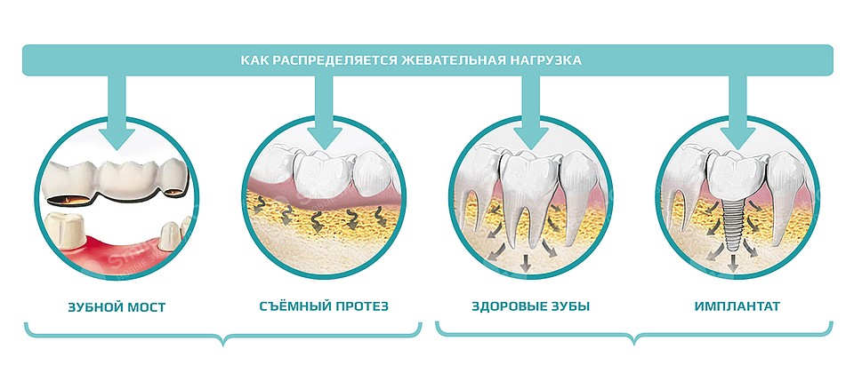 На фото наглядно продемонстрировано, какое влияние оказывают на десны и костную ткань живые зубы и различные протезы. 