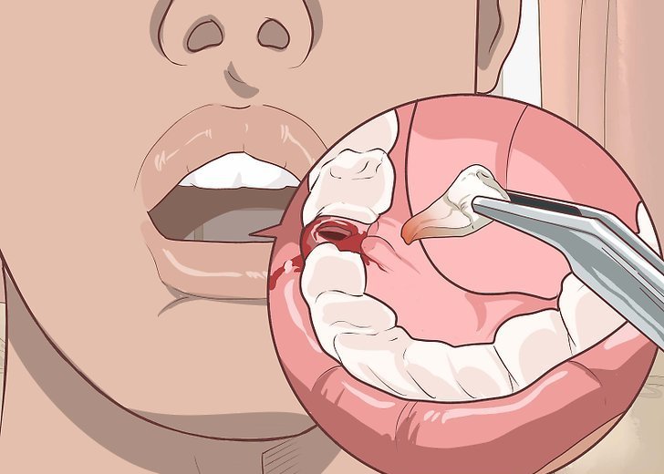 как остановить кровь после удаления зуба