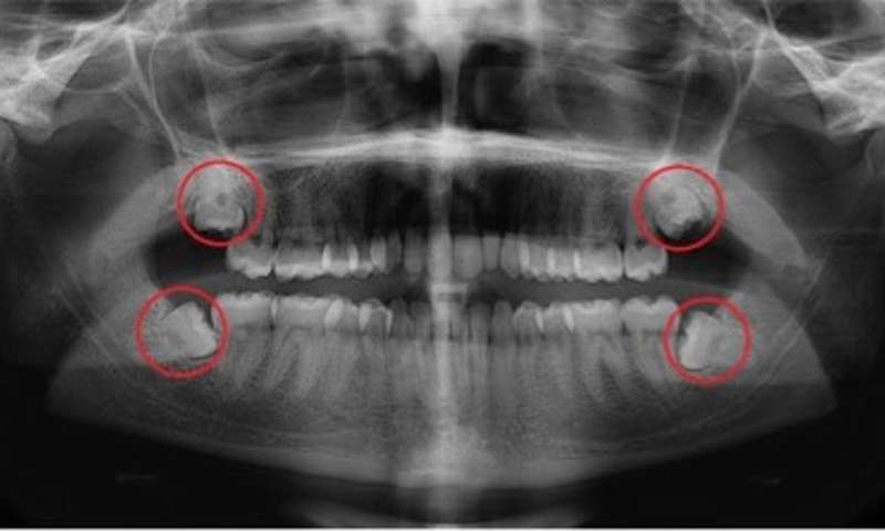 What are wisdom teeth, and should you have them removed?
