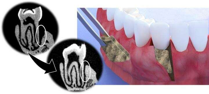 New membrane class shown to regenerate tissue and bone, viable solution for periodontitis