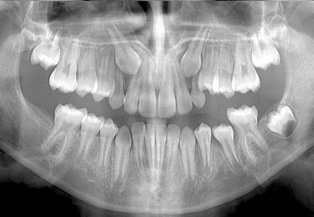 Ретинированные зубы на снимке