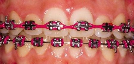 Эластичная цепочка для зубов