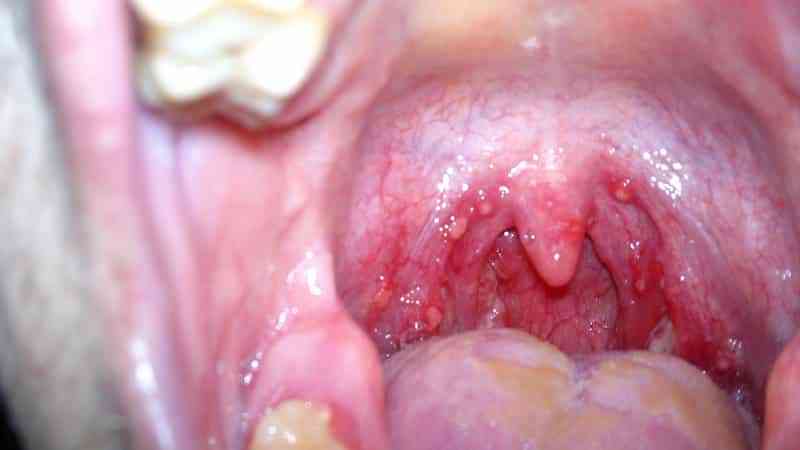 Лечение стоматита на миндалинах у взрослых