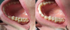 Чем и как пломбируют зубы: световые (фотополимерные), химические и другие виды пломб в стоматологии