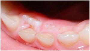 Чем моляры отличаются от премоляров, какими симптомами сопровождается прорезывание этих зубов у детей?