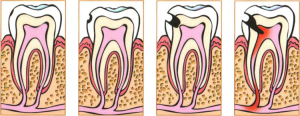 Принципы препарирования кариозной полости этапы и режимы ее формирования с учетом иммунных зон зуба