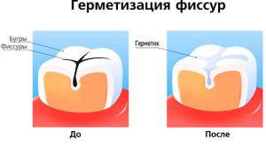 Лечение фиссурного кариеса с помощью герметизации (запечатывания) фиссур зубов