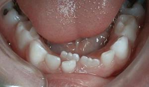 Какие зубы у детей молочные, есть ли у них корни, как их отличить от постоянных единиц?