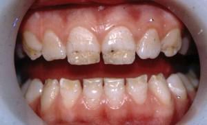 Виды гипоплазии эмали у детей с фото: способы лечения зубов Гетчинсона и других ее проявлений
