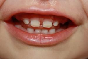 Со скольки лет начинать чистить зубы ребенку, каковы симптомы аллергии на зубную пасту?