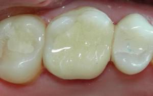Чем и как пломбируют зубы: световые (фотополимерные), химические и другие виды пломб в стоматологии