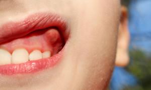 Что делать, если на десне над зубом появилась шишка: фото и лечение гнойных и твердых уплотнений