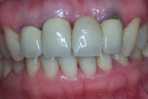 Почему у ребенка при прорезывании молочных зубов на десне возник синяк: причины гематомы