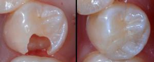 Как пломбируют зуб в стоматологии и можно ли поставить пломбу в домашних условиях самому: видео-советы