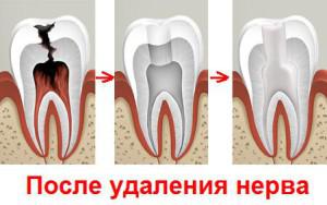 Почему после удаления нерва болит зуб при нажатии: причины неприятных ощущений после пломбирования и чистки каналов