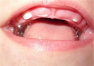 Чем моляры отличаются от премоляров, какими симптомами сопровождается прорезывание этих зубов у детей?