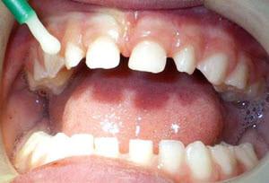 Покрытие для зубов Фторлак: состав и инструкция по применению средства в домашних условиях и у стоматолога