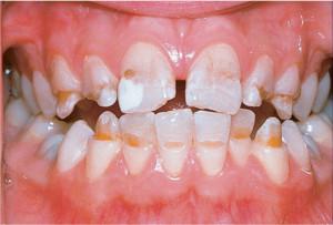 Виды гипоплазии эмали у детей с фото: способы лечения зубов Гетчинсона и других ее проявлений