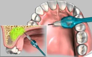 Виды анестезии при лечении зубов: какие анестетики и обезболивающие препараты используются в стоматологии?