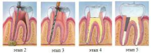 Почему после удаления нерва болит зуб при нажатии: причины неприятных ощущений после пломбирования и чистки каналов