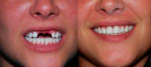 Как выглядят протезы бабочка во рту при отсутствии 1-2 зубов: фото до и после микропротезирования