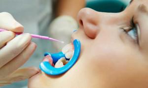 Покрытие для зубов Фторлак: состав и инструкция по применению средства в домашних условиях и у стоматолога