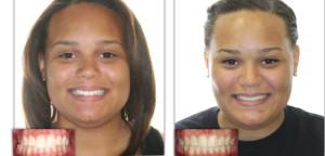 Формирование перекрестного прикуса со смещением нижней челюсти: лечение в ортодонтии с фото до и после исправления