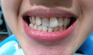 Формирование перекрестного прикуса со смещением нижней челюсти: лечение в ортодонтии с фото до и после исправления