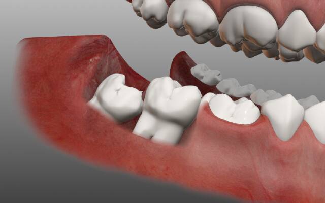 пятая причина кривых зубов - зубам мудрости элементарно не хватает места в зубном ряду