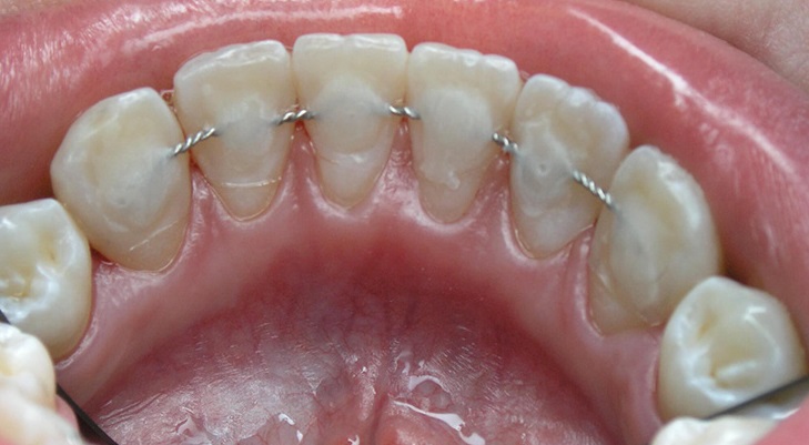 Несъемные ретейнеры в виде фиксирующей проволоки, которая крепится с внутренней стороны зубов. Один из вариантов крепления
