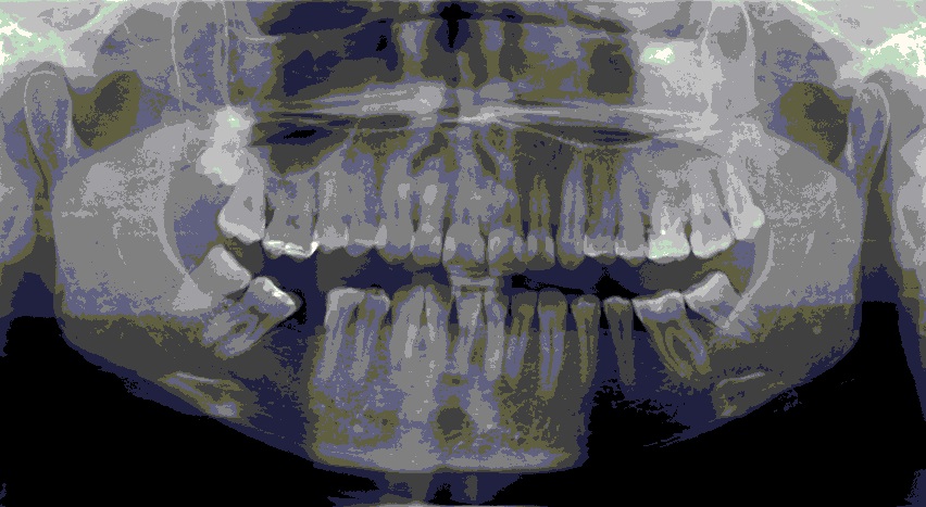 На ортопантомограмме мы видим множественные пломбы на зубах, отсутствие 6 нижнего правого зуба
