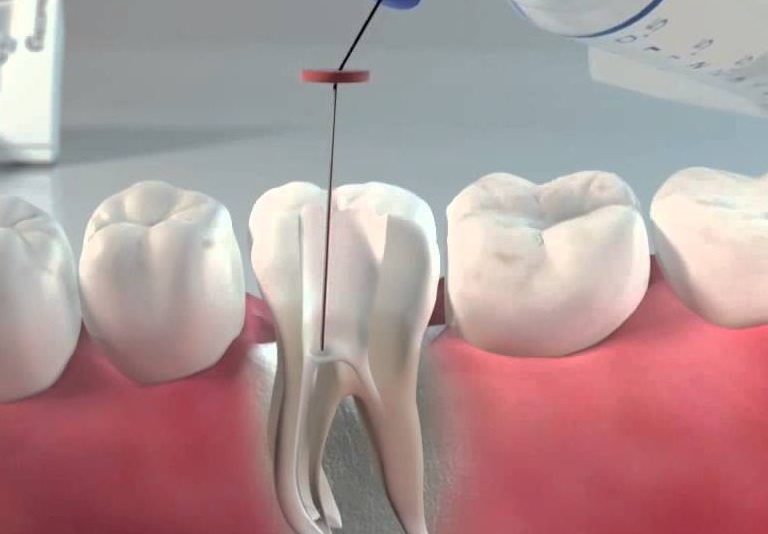 Плохая, неполная, некачественная чистка канала зуба и кариозных полостей на зубе - причина потемнения зуба