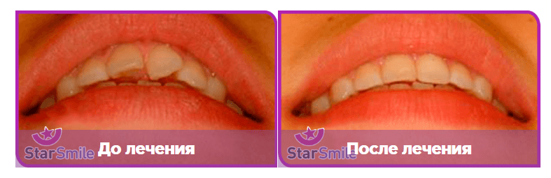 Выравнивание зубов элайнерами на примере поворота передних зубов