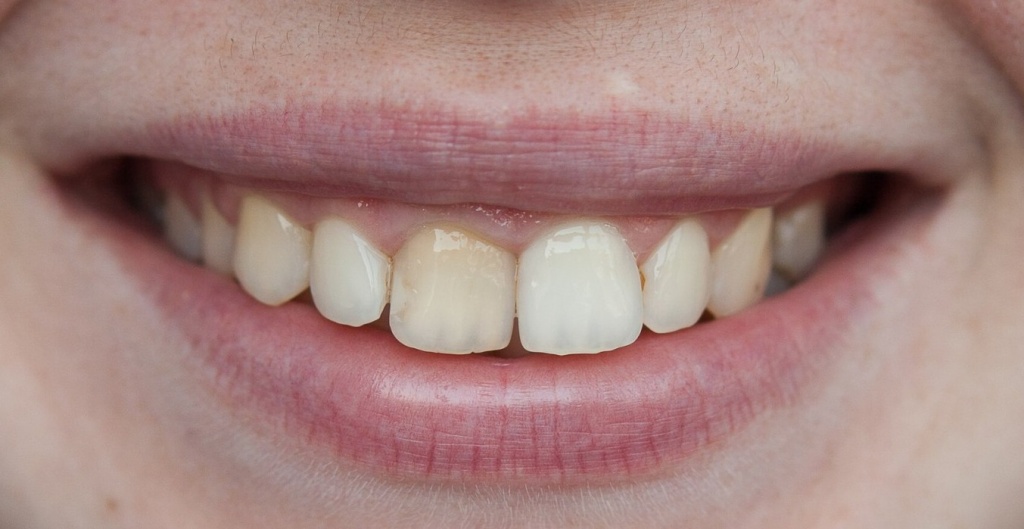 Если обратили внимание что зуб потемнел - то самое время обратиться к врачу эндодонтисту. Особенно если планируете исправлять прикус на элайнерах или брекетах. 