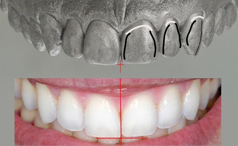 Системный подход к моделированию фронтальных зубов