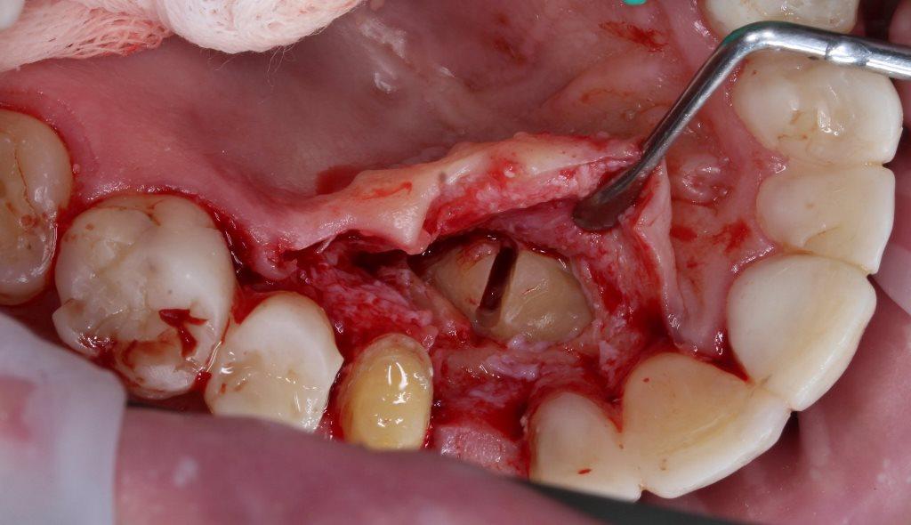Удаление ретинированного клыка верхней челюсти с одномоментной имплантацией